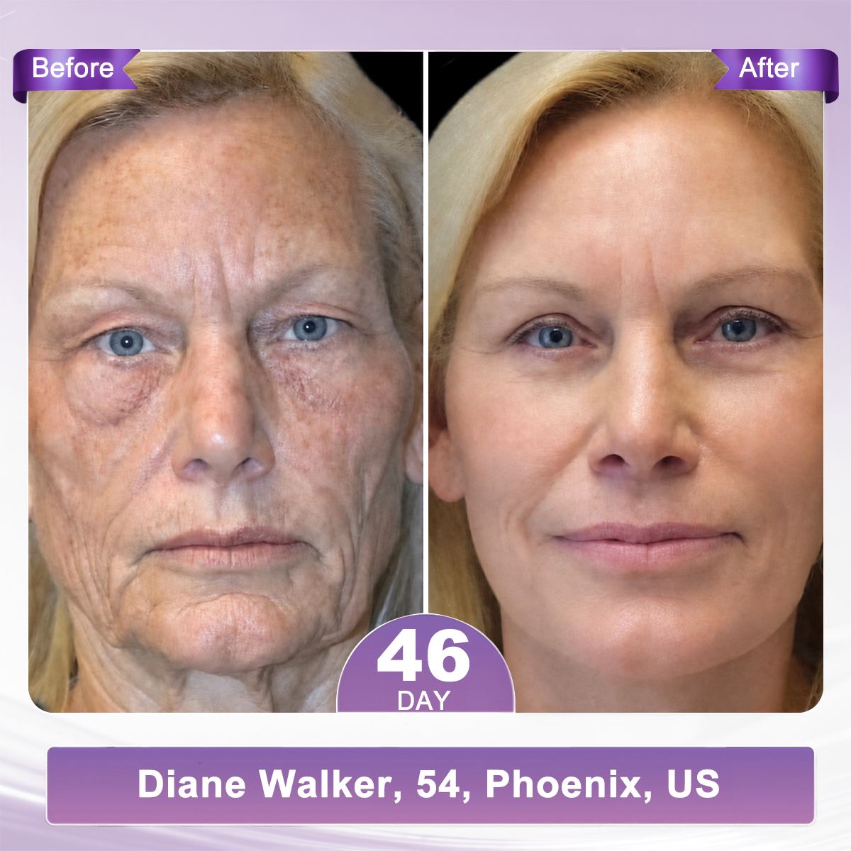 2 FDA Official: 𝐇𝐈𝐒𝐊𝐈𝐍® 𝐏𝐃𝐑𝐍 𝐌𝐮𝐥𝐭𝐢-𝐏𝐞𝐩𝐭𝐢𝐝𝐞 𝐌𝐚𝐬𝐬𝐚𝐠𝐢𝐧𝐠 𝐁𝐨𝐝𝐲 𝐑𝐨𝐥𝐥𝐞𝐫 𝐂𝐫𝐞𝐚𝐦- Anti-aging, Hydrating, Skin Firming & Lifting, Skin Repair, Even Tone, Acne and Dark Spot Treatment, Wart and Mole Removal, and Psoriasis Relief.